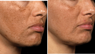 Before and After laser patient