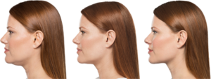 Before and After Kybella Treatment
