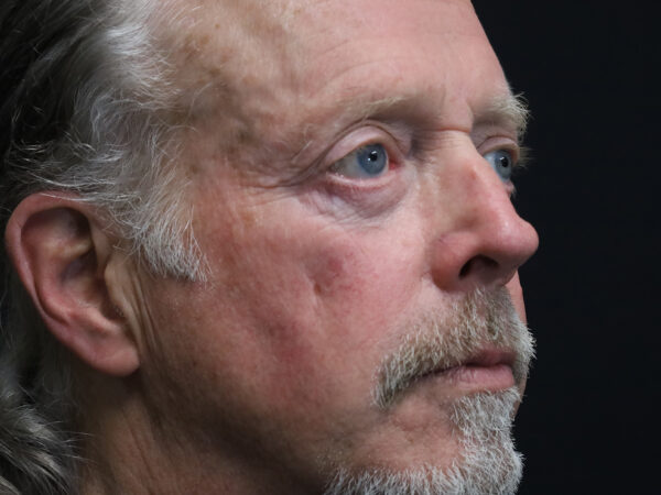 Eyelid Surgery Patient 25 After 1