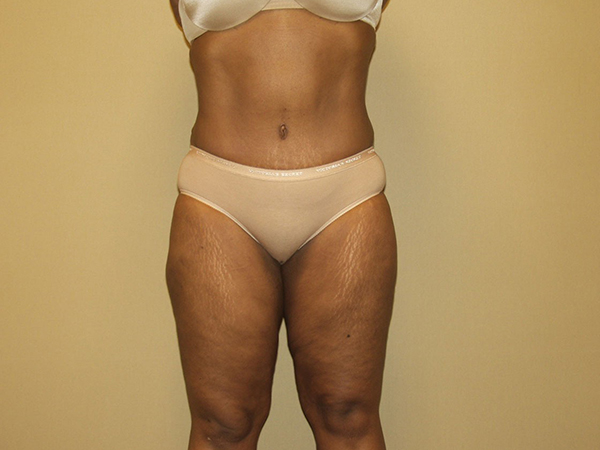 Tummy Tuck Patient 16 After 1
