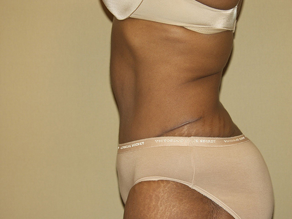 Tummy Tuck Patient 16 After 2
