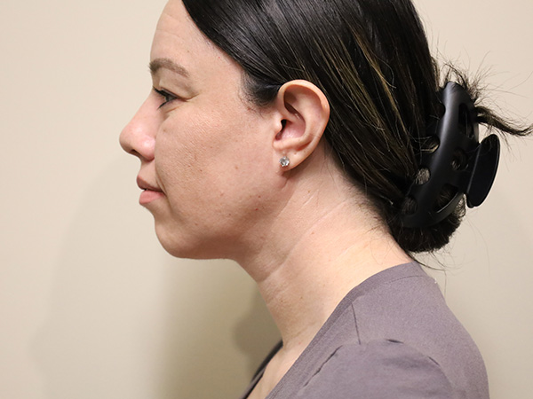 Neck Liposuction Patient 1 After 1