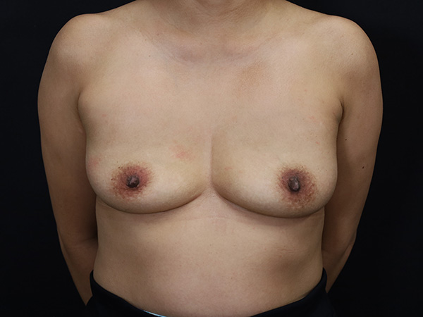 Breast Implant Removal Patient 16 After 1