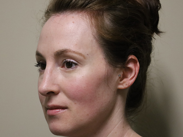 Rhinoplasty Patient 50 After 2