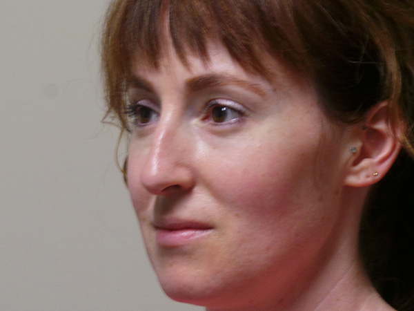 Rhinoplasty Patient 50 Before 2