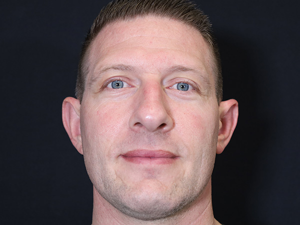 Otoplasty Patient 06 After 1