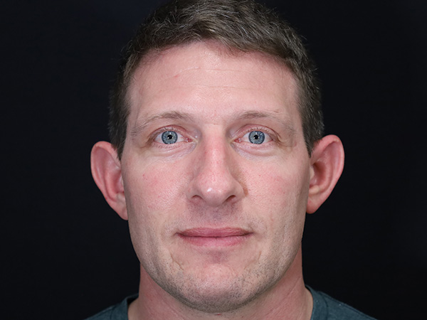 Otoplasty Patient 06 Before 1