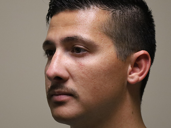 Rhinoplasty Patient 49 After 2