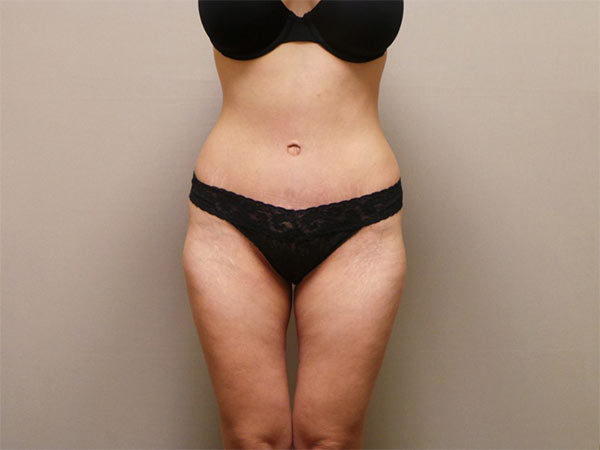 Tummy Tuck Patient 01 After 1