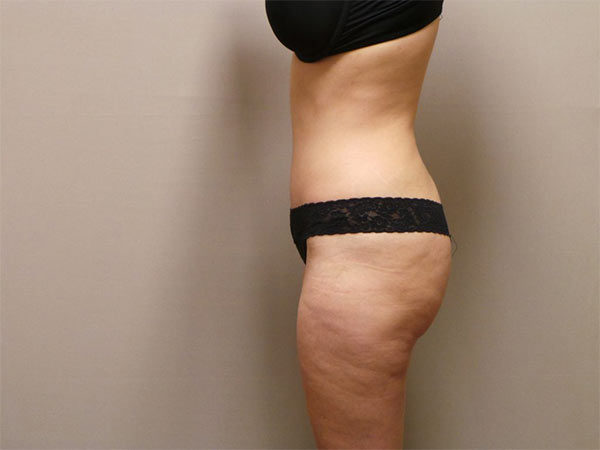 Tummy Tuck Patient 01 After 2