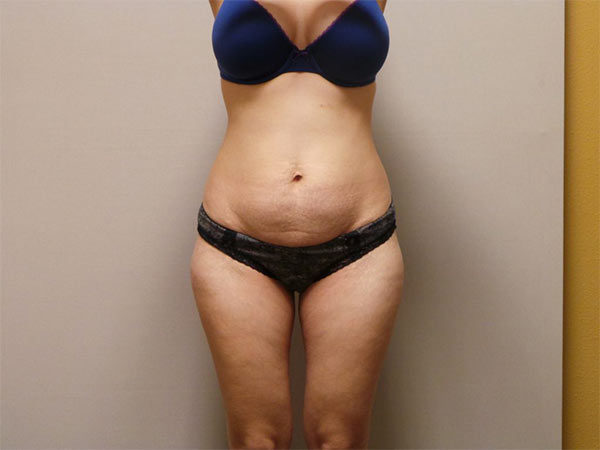 Tummy Tuck Patient 01 Before 1