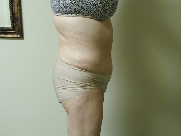 Tummy Tuck Patient 11 After 1
