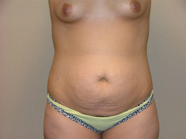 Tummy Tuck Patient 15 Before 1