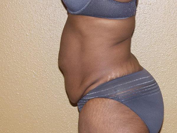 Tummy Tuck Patient 16 Before 2