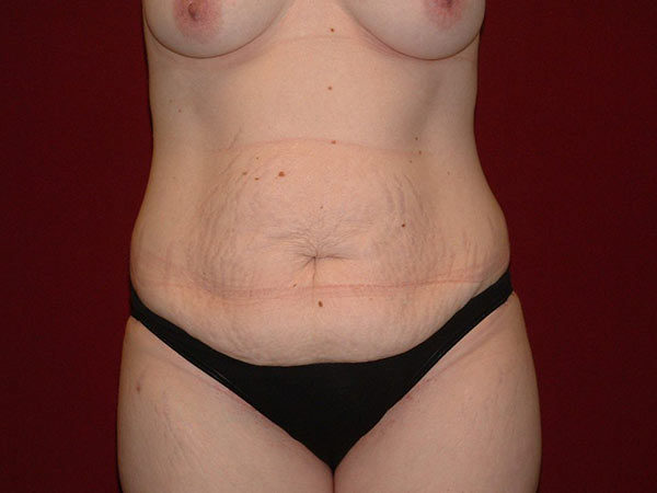 Tummy Tuck Patient 19 Before 1