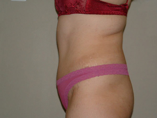 Tummy Tuck Patient 20 After 2