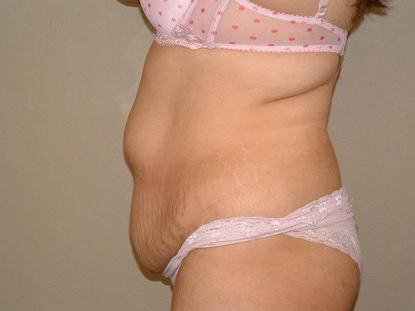 Tummy Tuck Patient 20 Before 2