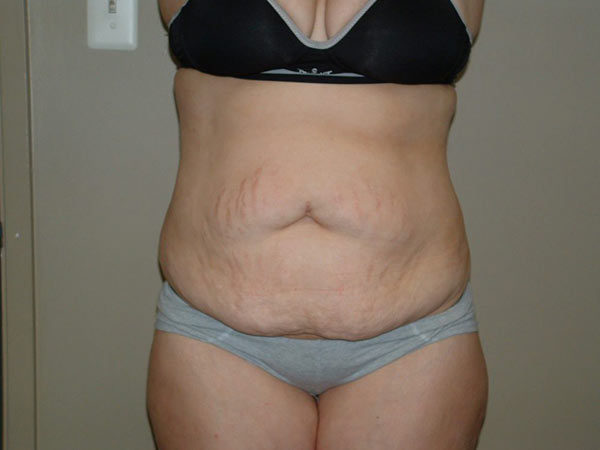 Tummy Tuck Patient 21 Before 1