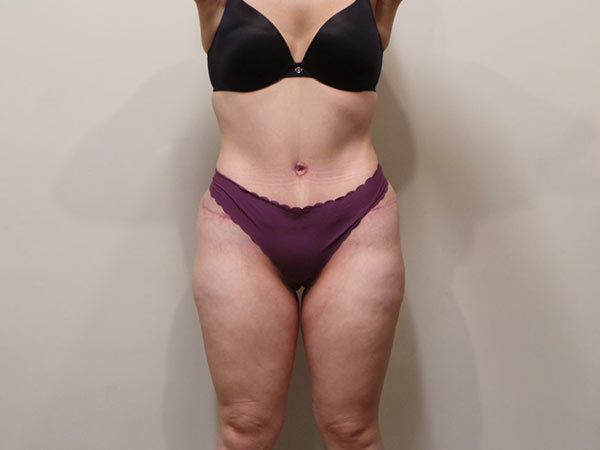 Tummy Tuck Patient 02 After 1