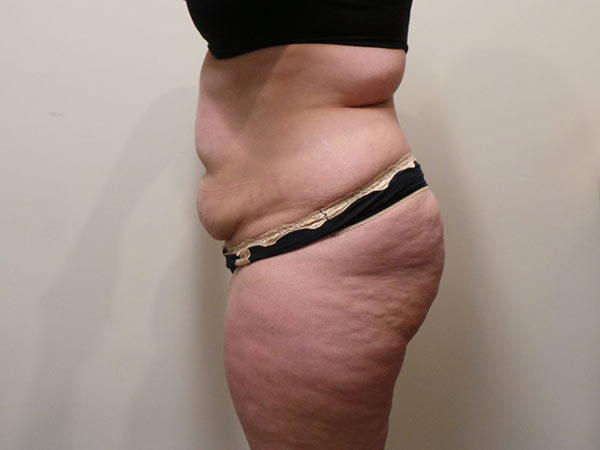 Tummy Tuck Patient 03 Before 2