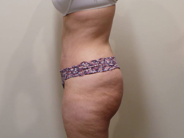 Tummy Tuck Patient 04 After 2