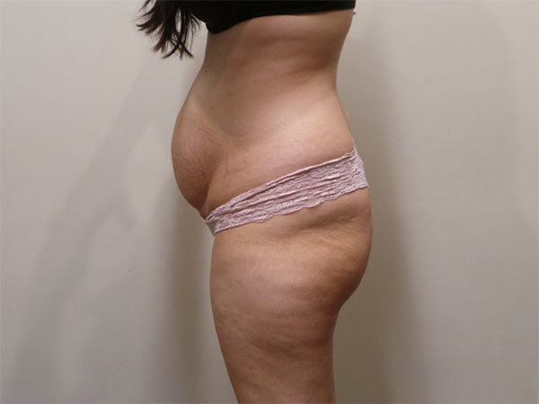 Tummy Tuck Patient 04 Before 2