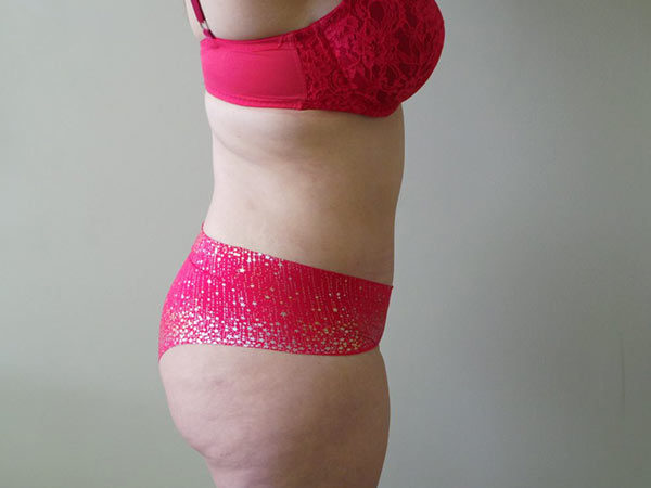 Tummy Tuck Patient 06 After 2