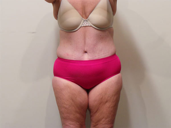 Tummy Tuck Patient 07 After 1