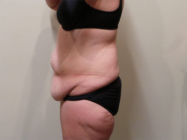 Tummy Tuck Patient 07 Before 2
