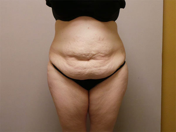 Tummy Tuck Patient 08 Before 1