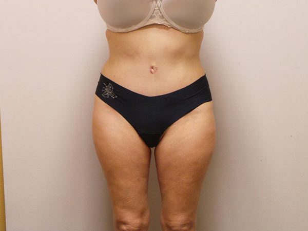 Tummy Tuck Patient 09 After 1