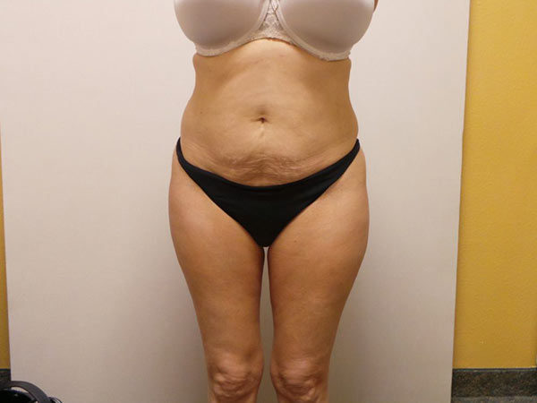 Tummy Tuck Patient 09 Before 1