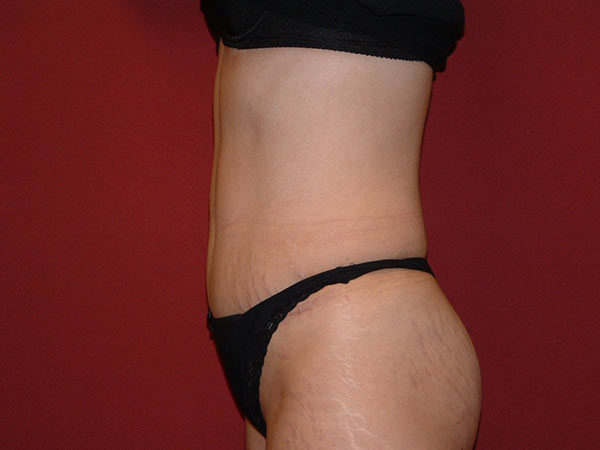Tummy Tuck Patient 10 After 2
