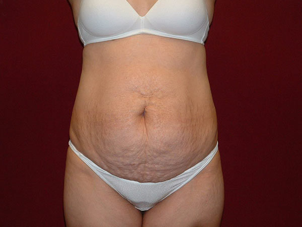 Tummy Tuck Patient 10 Before 1
