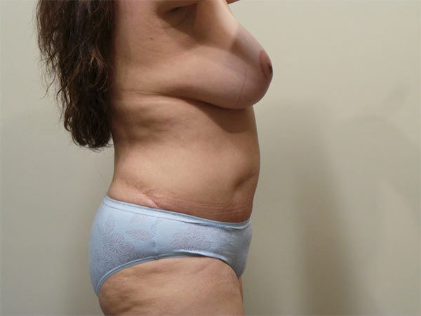 Tummy Tuck Patient 12 After 2