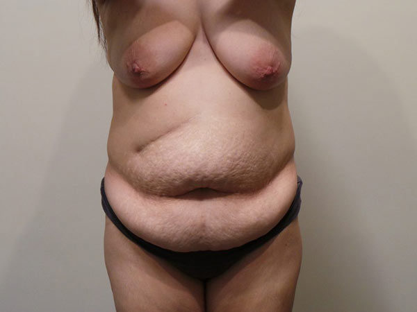 Tummy Tuck Patient 12 Before 1