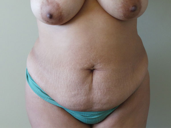Abdominoplasty Case 25 Before 1