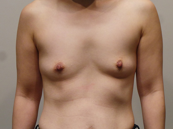 Breast Augmentation Patient 13 Before 1