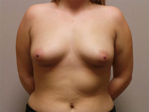 Breast Augmentation Patient 26 Before 1
