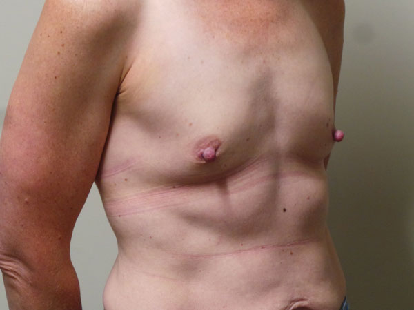 Breast Augmentation Patient 61 Before 2