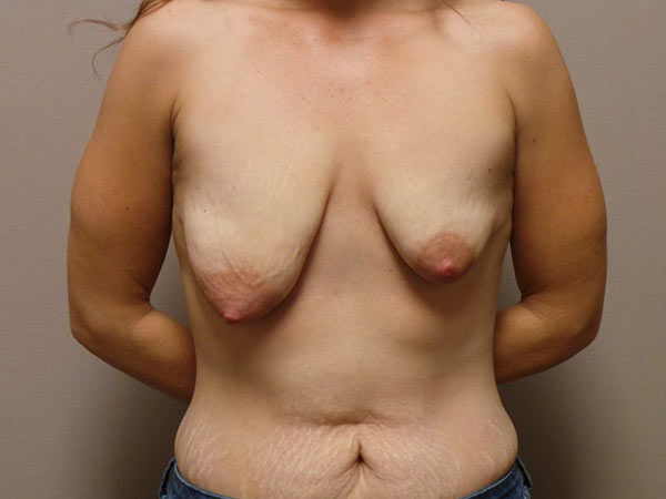 Breast Augmentation with Lift Patient 13 Before 2