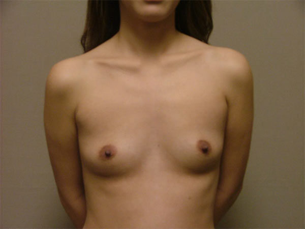Breast Augmentation Patient 28 Before 1