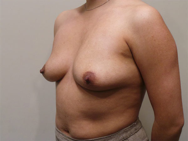 Breast Augmentation Patient 05 Before 2