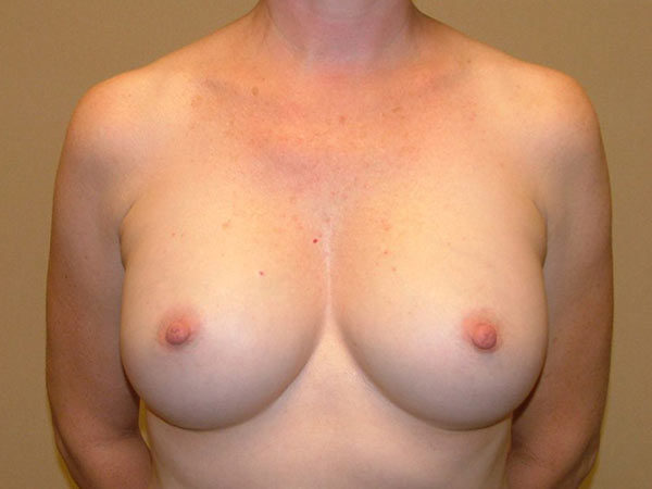 Breast Augmentation Patient 16 After 1