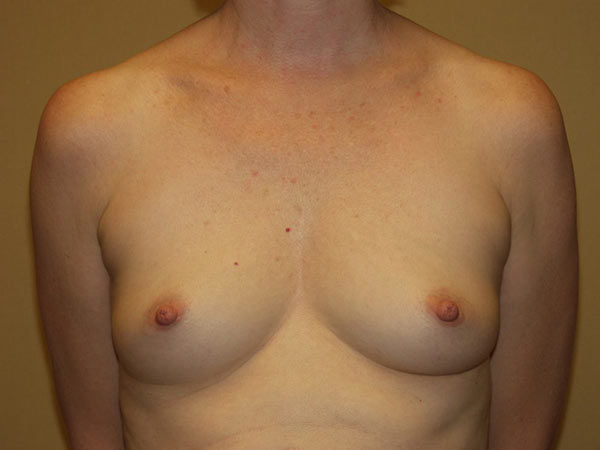 Breast Augmentation Patient 16 Before 1