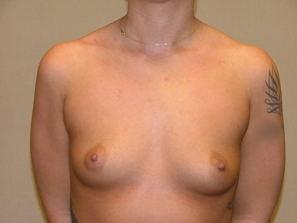Breast Augmentation Patient 15 Before 1