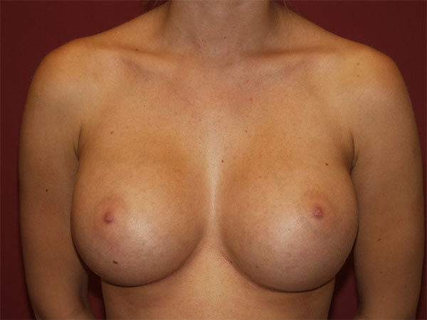 Breast Augmentation Patient 19 After 1