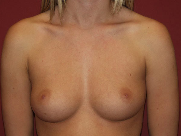 Breast Augmentation Patient 19 Before 1