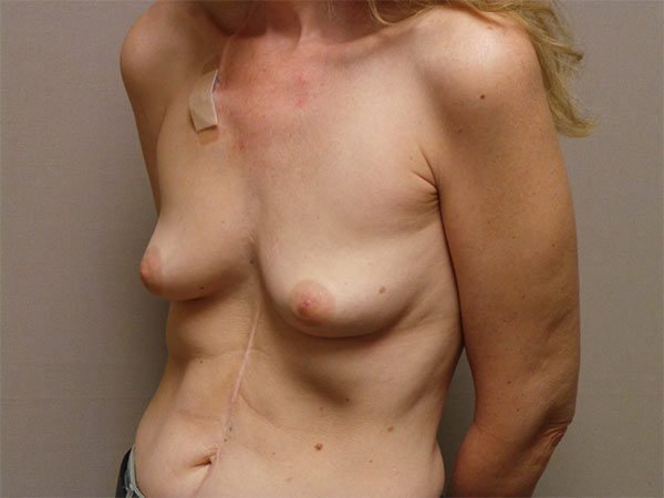 BREAST RECONSTRUCTION PATIENT 02 Before 2