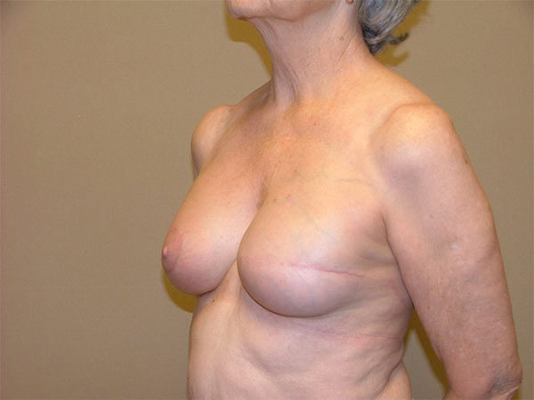 Breast Reconstruction Patient 03 After 2
